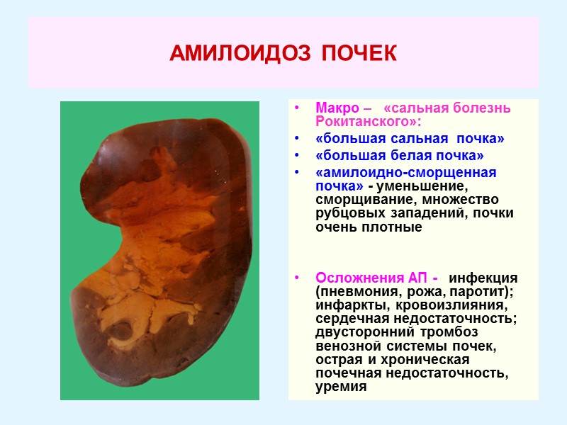 АМИЛОИДОЗ ПОЧЕК Макро –   «сальная болезнь Рокитанского»: «большая сальная  почка» «большая